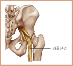 좌골신경 이미지