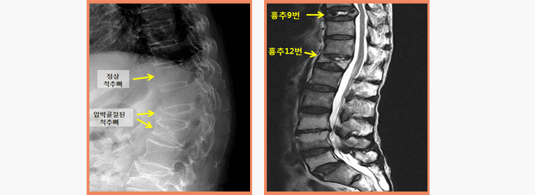 흉추압박골절 X-Ray사진