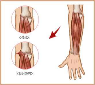 테니스엘보 사진