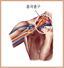 흉곽출구 사진